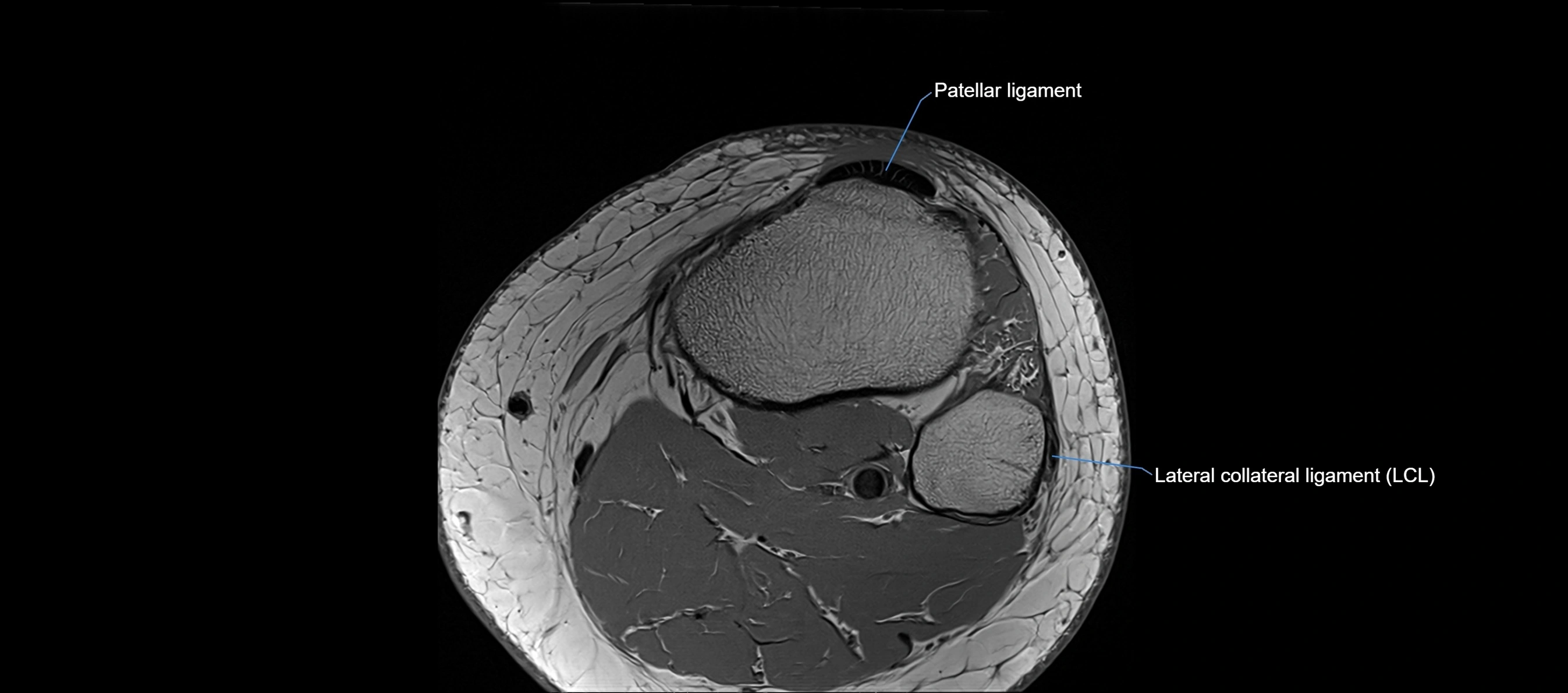 MRI Knee axial  ligaments cross sectional anatomy 3T  radiology  image-img-03001-00043.webp